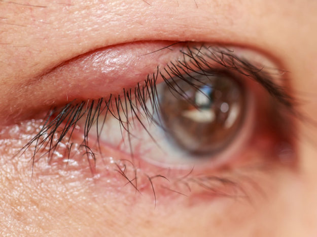 blefaritis blefaritis