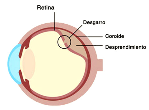 desprendimiento de retina