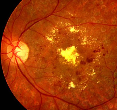 retinopatíaa Diabética